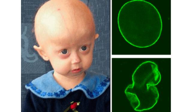 Is Progeria a disease of Accelerated Aging?