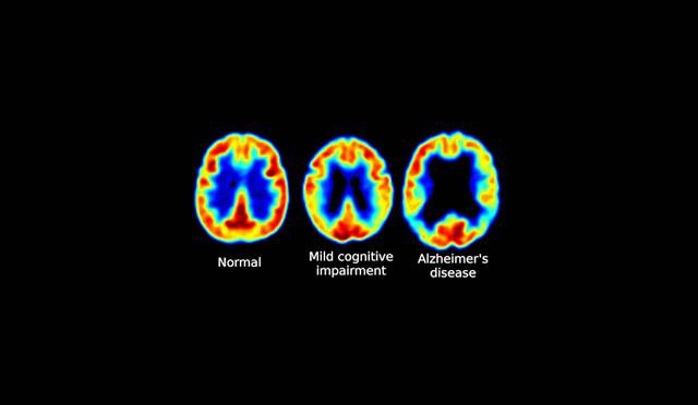 B Vitamins and the Aging Brain